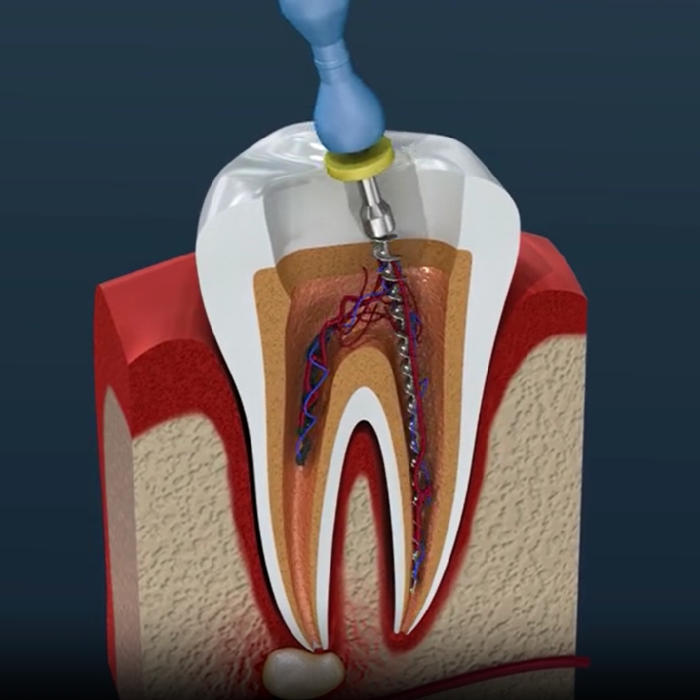 INVISALIGN
